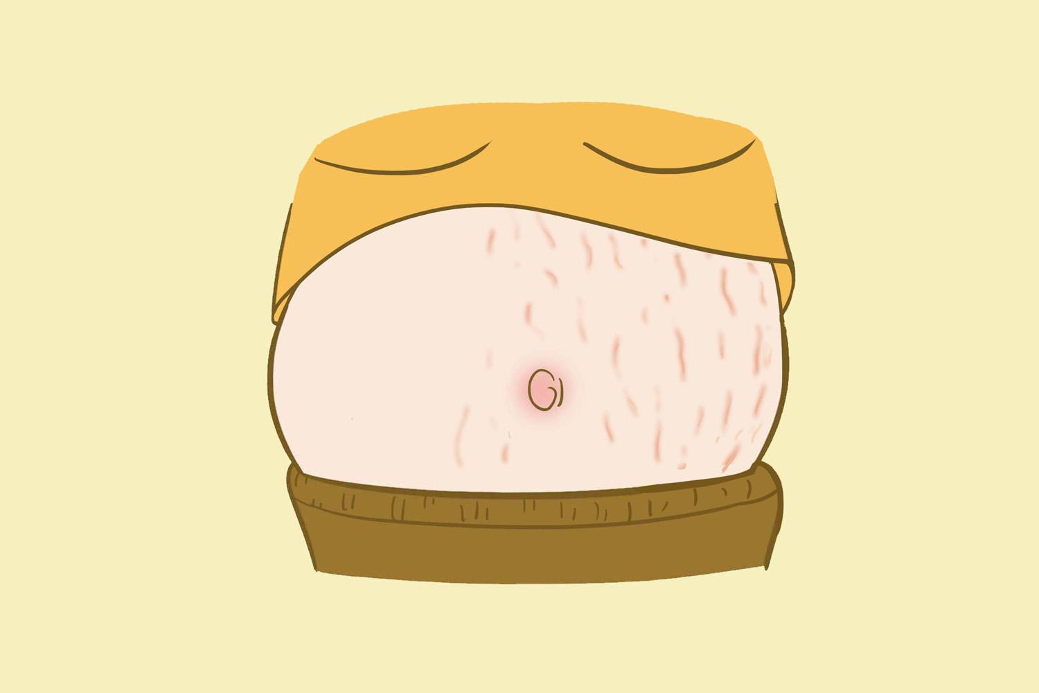 怎么去妊娠纹最有效的方法,解决方法都在这里