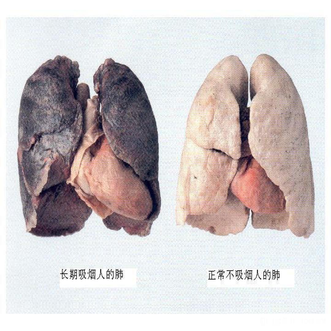 吸烟人的肺 15年图片