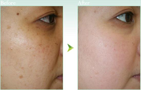 祛斑 祛斑 头条百科