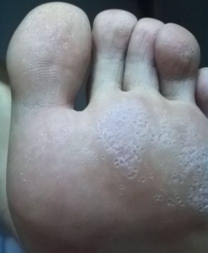 足癣 快懂百科