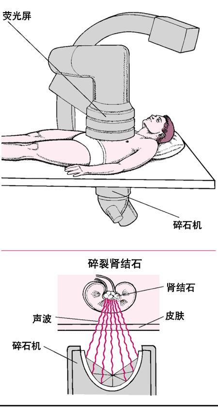 体外震波碎石术 快懂百科