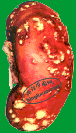 图9肾多发性脓肿多发散在黄白色脓肿灶