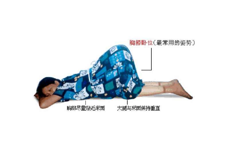 膝胸卧位 快懂百科
