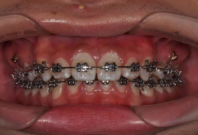 矫正器 快懂百科