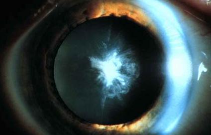 职业性白内障 快懂百科