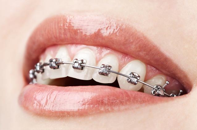 矫正牙齿 矫正牙齿 头条百科