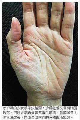 性联鱼鳞癣 快懂百科