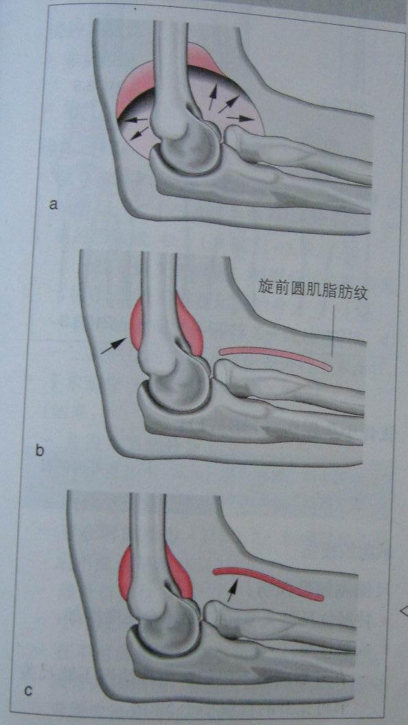 脂肪垫征 快懂百科