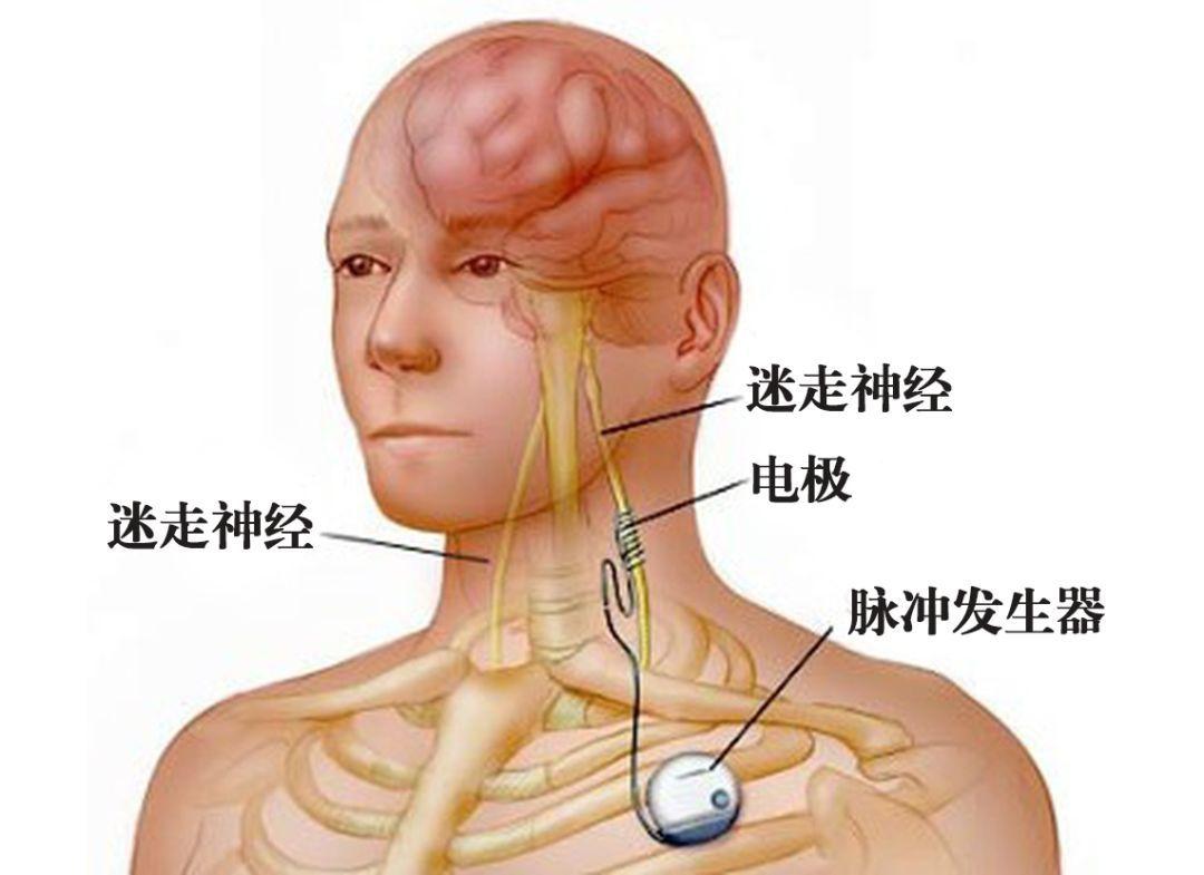 迷走神经性昏厥 快懂百科