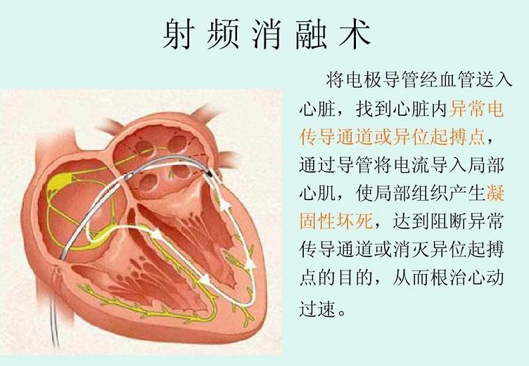 射频消融术