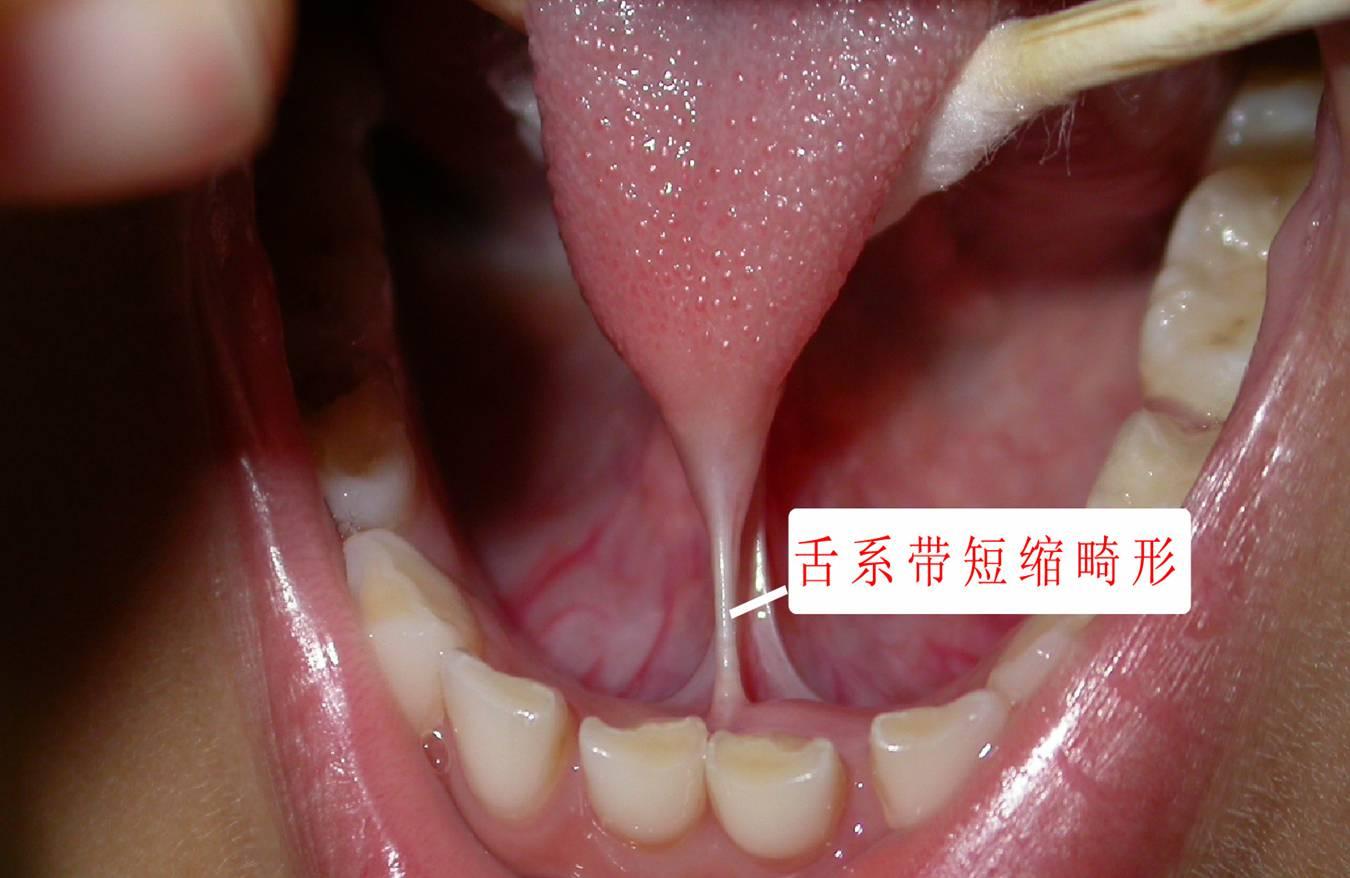 舌系带畸形